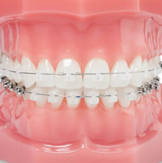 Brackets de porcelana